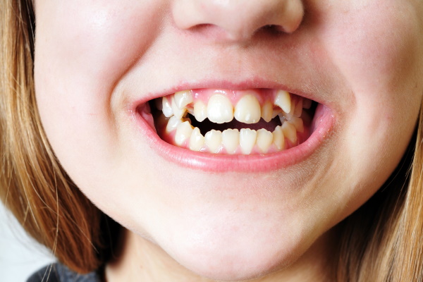 close up - bad  crooked teeth of girl